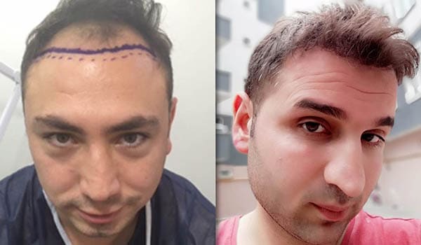 Öncesi & Sonrası <br> Cyprus Hair Center