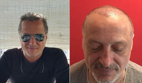 Öncesi & Sonrası <br> Cyprus Hair Center