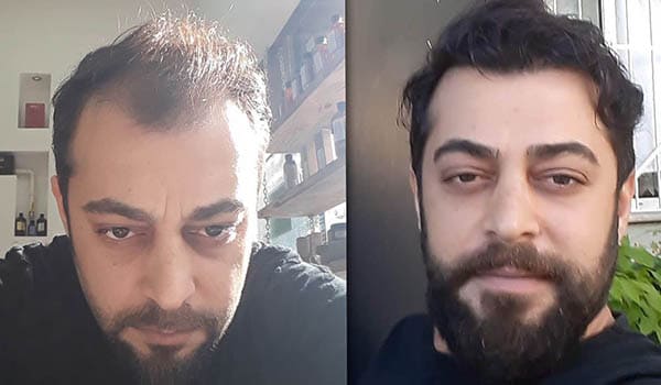 Öncesi & Sonrası <br> Cyprus Hair Center