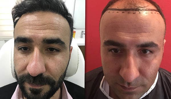 Öncesi & Sonrası <br> Cyprus Hair Center