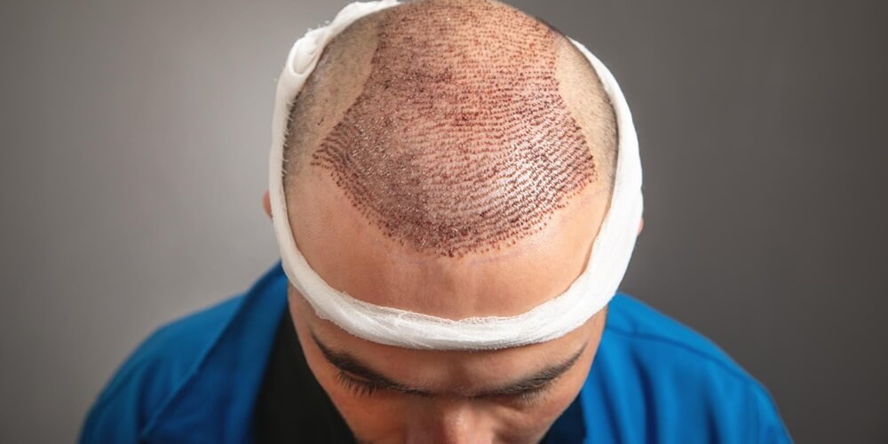 dhi-teknigi-ve-safir-sac-ekimi-arasındaki-fark nedir-hangisi daha-iyi-01_2