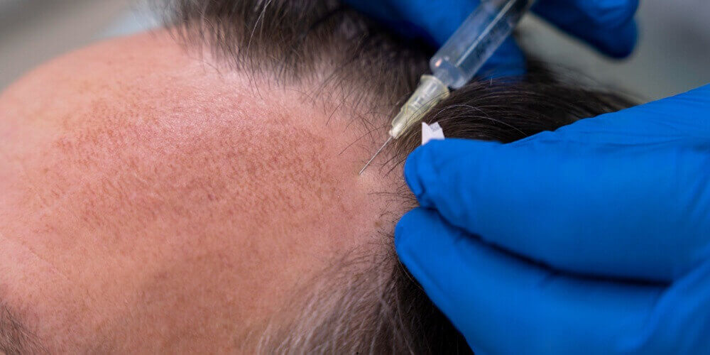 dhi-teknigi-ve-safir-sac-ekimi-arasındaki-fark nedir-hangisi daha-iyi-02_1