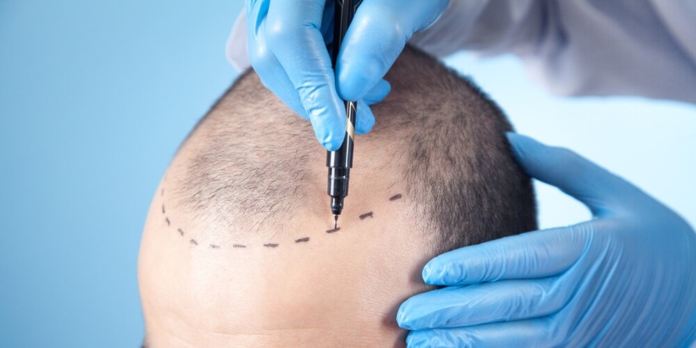 t&uuml;rkiye-mi-kibris-mi-sac-ekimi-icin-en-dogru-ulke- hangisi-maliyet-ve-karsilastirma-01_1